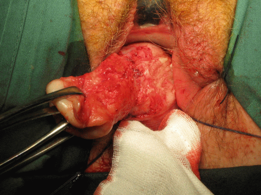 vaginal prolapse surgery hysterectomy1
